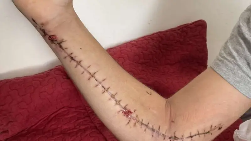 Des nouvelles de Louis, gravement blessé par un sanglier il y a 1mois