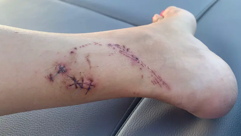 Une touriste sérieusement mordue par un brochet