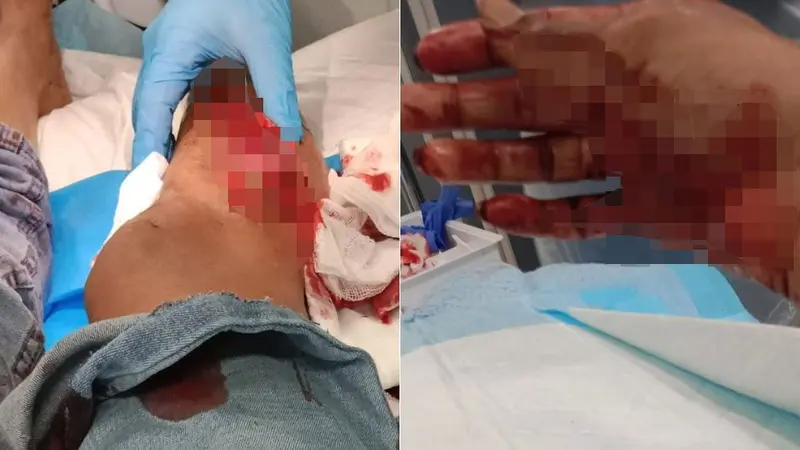 Un sanglier blesse gravement une animaliste qui a du subir plusieurs opérations