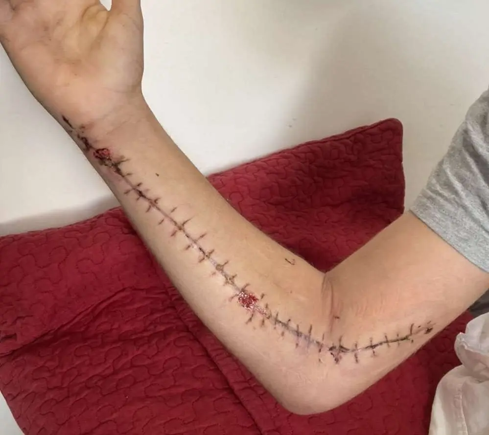 Des nouvelles de Louis, gravement blessé par un sanglier il y a 1mois