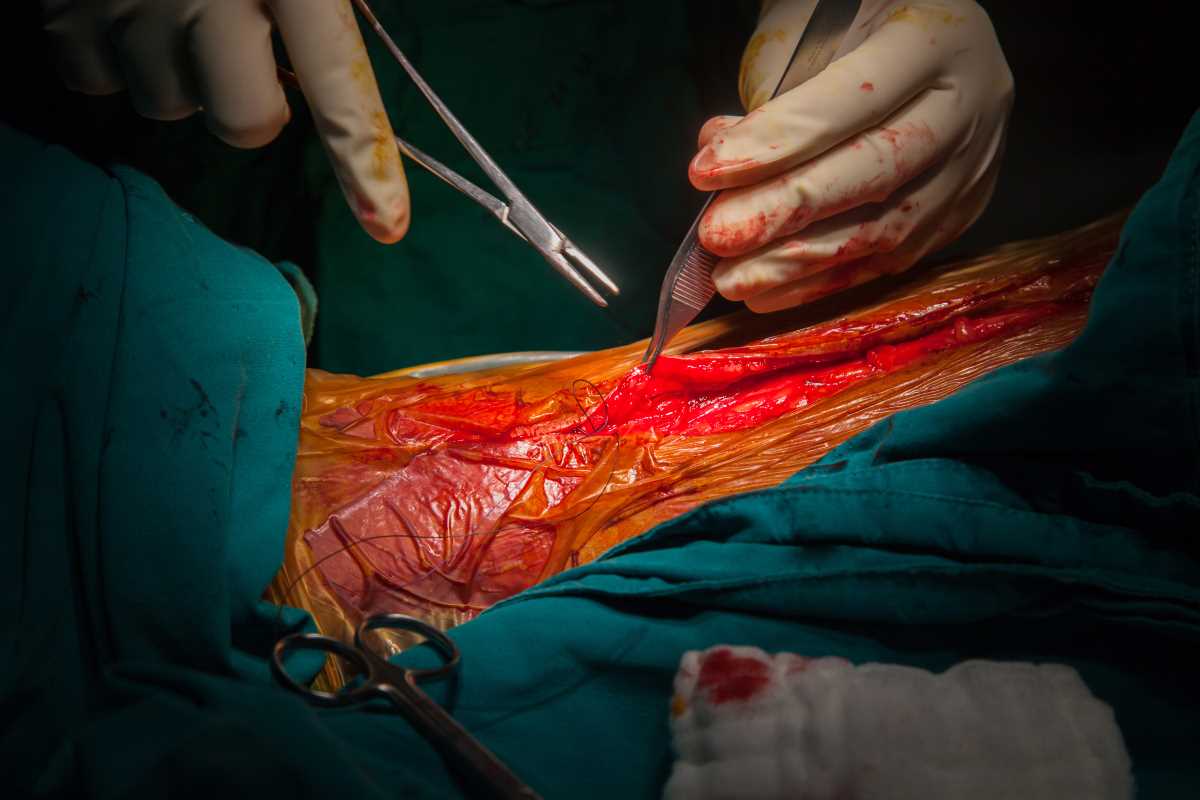 Lot-et-Garonne : 47 points de suture suite une charge de sanglier